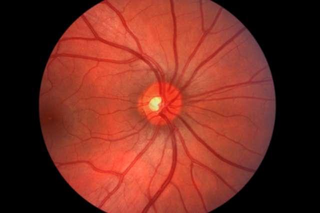 视网膜-视神经-人眼